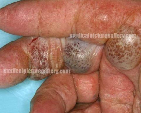 Dyshidrotic eczema or Pompholyx