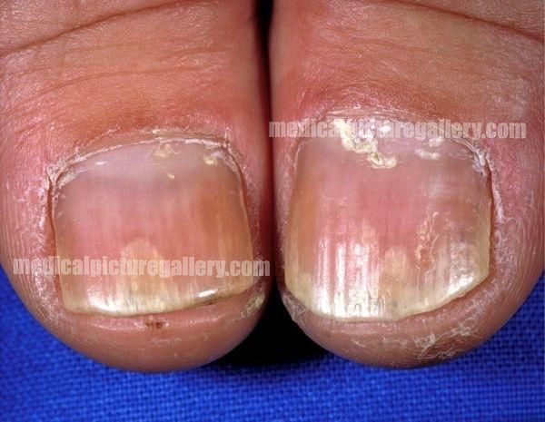 Nail psoriasis
