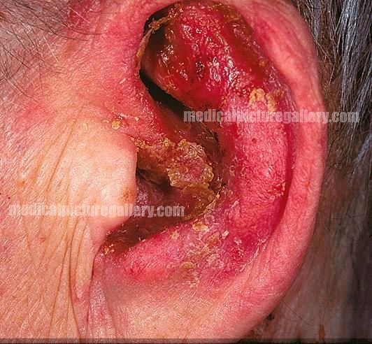 Psoriasis