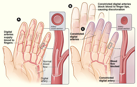 How Raynaud's syndrome affects blood vessels and circulation in the extremities