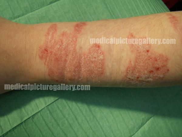 Koebner's phenomenon