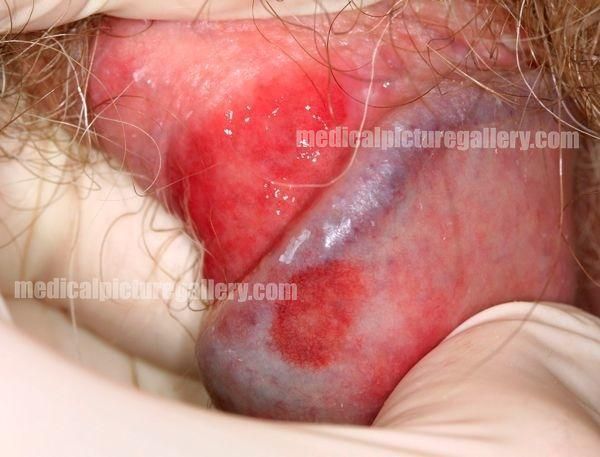 Balanitis circumscripta plasmacellularis